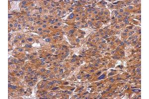 IHC-P Image Immunohistochemical analysis of paraffin-embedded human hepatoma, using SNX9, antibody at 1:500 dilution. (SNX9 antibody)