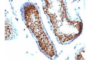 Formalin-fixed, paraffin-embedded human Testicular Carcinoma stained with SUMO-2 MAb (SUMO2/1199) (SUMO2 antibody)