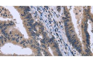 Immunohistochemistry of paraffin-embedded Human colon cancer tissue using KCNJ11 Polyclonal Antibody at dilution 1:40 (KCNJ11 antibody)