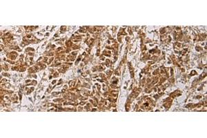 Immunohistochemistry of paraffin-embedded Human colorectal cancer tissue using HOXC5 Polyclonal Antibody at dilution of 1:55(x200) (Homeobox C5 antibody)