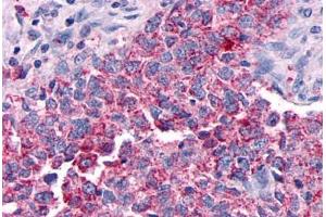 Anti-GPR30 antibody  ABIN1048792 IHC staining of human breast carcinoma. (GPER antibody  (Extracellular Domain))