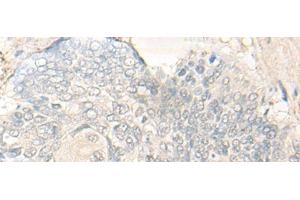 Immunohistochemistry of paraffin-embedded Human esophagus cancer tissue using DIMT1 Polyclonal Antibody at dilution of 1:30(x200) (DIMT1 antibody)