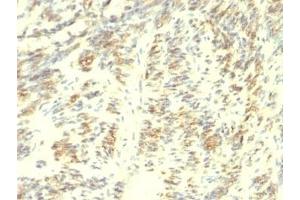 Formalin-fixed, paraffin-embedded human Leiomyosarcoma stained with Transglutaminase 2 antibody. (Transglutaminase 2 antibody)