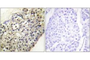Immunohistochemistry analysis of paraffin-embedded human breast carcinoma tissue, using LATH Antibody. (LATH antibody  (AA 71-120))