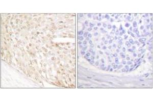 Immunohistochemistry analysis of paraffin-embedded human breast carcinoma tissue, using p18 INK Antibody. (P18 INK antibody  (AA 111-160))