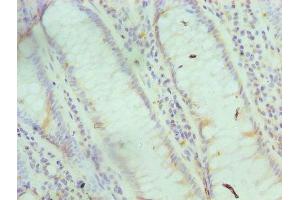 Immunohistochemistry of paraffin-embedded human colon cancer using ABIN7153695 at dilution of 1:100 (FABP6 antibody  (AA 1-128))