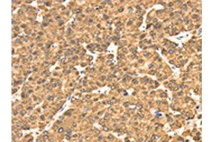 The image on the left is immunohistochemistry of paraffin-embedded Human liver cancer tissue using ABIN7130945(RRBP1 Antibody) at dilution 1/25, on the right is treated with fusion protein. (RRBP1 antibody)