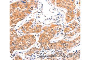 Immunohistochemistry of Human lung cancer using AMPD1 Polyclonal Antibody at dilution of 1:80