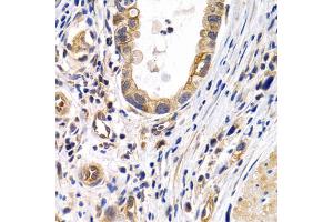Immunohistochemistry of paraffin-embedded human gastric cancer using PTGIR antibody. (Prostacyclin Receptor antibody)