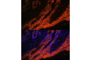 Immunofluorescence analysis of human skin cancer using IL1RA Rabbit mAb (ABIN7267971) at dilution of 1:100 (40x lens). (IL1RN antibody)