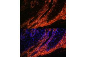 Immunofluorescence analysis of human skin cancer using IL1RA Rabbit mAb (ABIN7267971) at dilution of 1:100 (40x lens). (IL1RN antibody)
