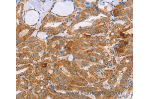 Immunohistochemistry of Human cervical cancer using CARD6 Polyclonal Antibody at dilution of 1:60 (CARD6 antibody)