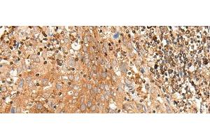 Immunohistochemistry of paraffin-embedded Human cervical cancer tissue using BAG3 Polyclonal Antibody at dilution of 1:35(x200) (BAG3 antibody)