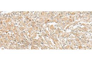 Immunohistochemistry of paraffin-embedded Human liver cancer tissue using GIPC1 Polyclonal Antibody at dilution of 1:50(x200) (GIPC1 antibody)
