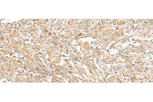 Immunohistochemistry of paraffin-embedded Human liver cancer tissue using GIPC1 Polyclonal Antibody at dilution of 1:50(x200) (GIPC1 antibody)