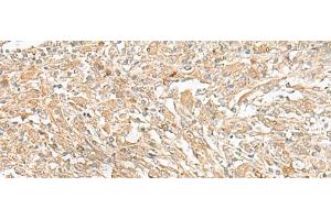 Immunohistochemistry of paraffin-embedded Human liver cancer tissue using GIPC1 Polyclonal Antibody at dilution of 1:50(x200)