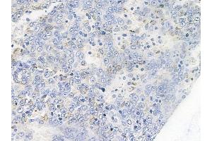 ABIN6255773 and ABIN6267263 at 1/100 staining human melanoma by IHC-P. (EGFR antibody  (pTyr1086, pTyr1110))