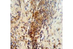 Immunohistochemistry analysis in human lung carcinoma (Formalin-fixed, Paraffin-embedded) using DNAJC11  Antibody (N-term), followed by peroxidase conjugated secondary antibody and DAB staining. (DNAJC11 antibody  (N-Term))