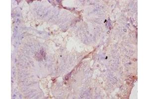 Immunohistochemistry of paraffin-embedded human colon cancer using ABIN7177698 at dilution of 1:10 (AMH antibody  (AA 450-552))