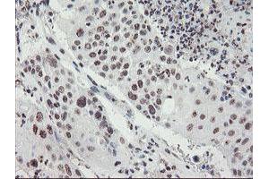 Immunohistochemical staining of paraffin-embedded Carcinoma of Human lung tissue using anti-MLF2 mouse monoclonal antibody. (MLF2 antibody)