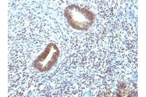 Formalin-fixed, paraffin-embedded human Uterine Carcinoma stained with MAP3K1 Mouse Monoclonal Antibody (2F6). (MAP3K1 antibody  (AA 1077-1176))