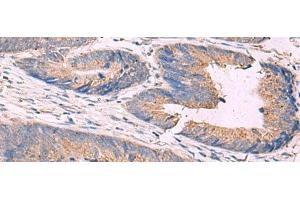 Immunohistochemistry of paraffin-embedded Human colorectal cancer tissue using KCNN3 Polyclonal Antibody at dilution of 1:40(x200) (KCNN3 antibody)