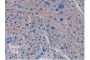 IHC-P analysis of Human Liver Cancer Tissue, with DAB staining. (IL-15 antibody  (AA 50-162))