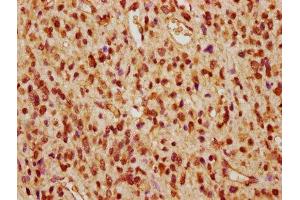 IHC image of ABIN7169270 diluted at 1:260 and staining in paraffin-embedded human glioma performed on a Leica BondTM system.