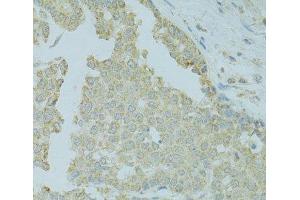 Immunohistochemistry of paraffin-embedded Human colon carcinoma using MTFP1 Polyclonal Antibody at dilution of 1:100 (40x lens).