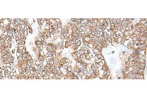 Immunohistochemistry of paraffin-embedded Human gastric cancer tissue using RNF111 Polyclonal Antibody at dilution of 1:50(x200) (RNF111 antibody)