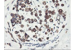 Immunohistochemical staining of paraffin-embedded Adenocarcinoma of Human colon tissue using anti-PFKP mouse monoclonal antibody. (PFKP antibody)