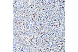 Immunohistochemistry of paraffin-embedded Human lymph node tumors using TP53I11 antibody (ABIN6131365, ABIN6149418, ABIN6149419 and ABIN6216636) at dilution of 1:100 (40x lens). (TP53I11 antibody  (AA 1-70))
