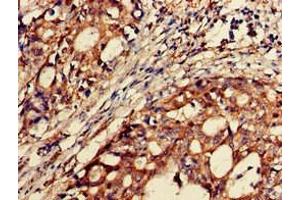 Immunohistochemistry of paraffin-embedded human gastric cancer using ABIN7145535 at dilution of 1:100 (BACE2 antibody  (AA 84-157))