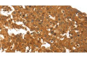Immunohistochemistry of paraffin-embedded Human breast cancer using TNFRSF11B Polyclonal Antibody at dilution of 1:30 (Osteoprotegerin antibody)