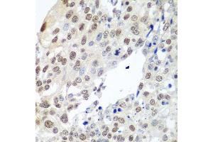 Immunohistochemistry of paraffin-embedded human lung cancer using PTTG1 antibody. (PTTG1 antibody  (AA 1-202))
