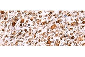 Immunohistochemistry of paraffin-embedded Human gastric cancer tissue using INO80 Polyclonal Antibody at dilution of 1:85(x200)