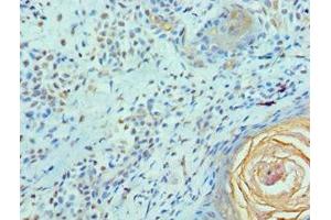 Immunohistochemistry of paraffin-embedded human breast cancer using ABIN7152098 at dilution of 1:100 (Elf4 antibody  (AA 1-200))