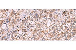 Immunohistochemistry of paraffin-embedded Human liver cancer tissue using JAZF1 Polyclonal Antibody at dilution of 1:35(x200) (JAZF1 antibody)