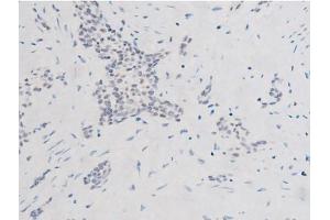 ABIN6267524 at 1/200 staining Human bladder cancer tissue sections by IHC-P. (SYK antibody  (pTyr525))