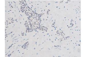 ABIN6267524 at 1/200 staining Human bladder cancer tissue sections by IHC-P.