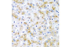 Immunohistochemistry of paraffin-embedded human liver injury using WNT2 antibody at dilution of 1:200 (40x lens).