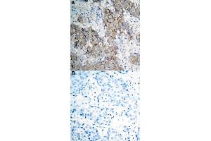 Immunohistochemical staining of human breast cancer tissue by IGF1R (phospho Y1161) polyclonal antibody  without blocking peptide (A) or preincubated with blocking peptide (B) under 1:50-1:100 dilution. (IGF1R antibody  (pTyr1161))