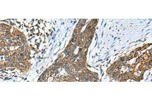 Immunohistochemistry of paraffin-embedded Human esophagus cancer tissue using PREPL Polyclonal Antibody at dilution of 1:55(x200) (PREPL antibody)