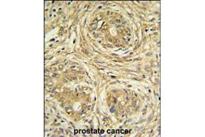 SUPV3L1 Antibody IHC analysis in formalin fixed and paraffin embedded prostate carcinoma followed by peroxidase conjugation of the secondary antibody and DAB staining. (SUPV3L1 antibody  (N-Term))