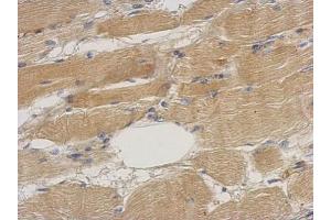 IHC-P Image Immunohistochemical analysis of paraffin-embedded human gastric cancer, using Septin 2, antibody at 1:500 dilution. (Septin 2 antibody)