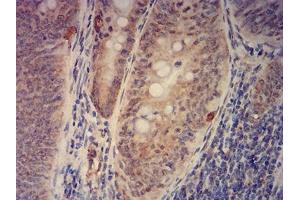 Immunohistochemical analysis of paraffin-embedded rectum cancer tissues using KAT2B mouse mAb with DAB staining. (KAT2B antibody  (AA 1-142))