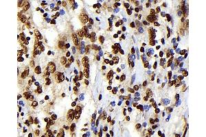 Immunohistochemistry analysis of paraffin-embedded human lymphoma using S100A4 Monoclonal Antibody at dilution of 1:300. (s100a4 antibody)