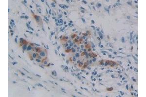 Detection of iPLA2 in Human Pancreatic cancer Tissue using Polyclonal Antibody to Phospholipase A2, Calcium Independent (iPLA2) (PNPLA2 antibody  (AA 484-701))