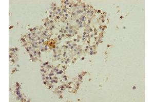 Immunohistochemistry of paraffin-embedded human breast cancer using ABIN7150890 at dilution of 1:100 (DNAL4 antibody  (AA 1-105))