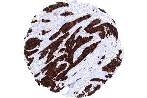 Muscle invasive urothelial carcinoma of the urinary bladder showing a strong S100P immunostaining of tumor cells (Recombinant S100P antibody  (C-Term))